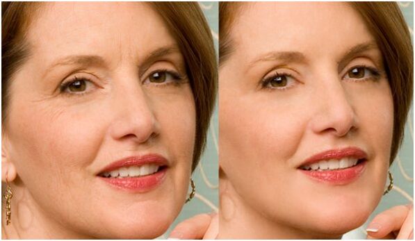 pred a po plazmatickom omladení pokožky tváre