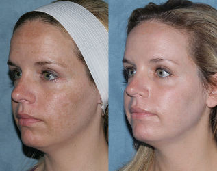 Pred a po frakčnou omladenie tváre
