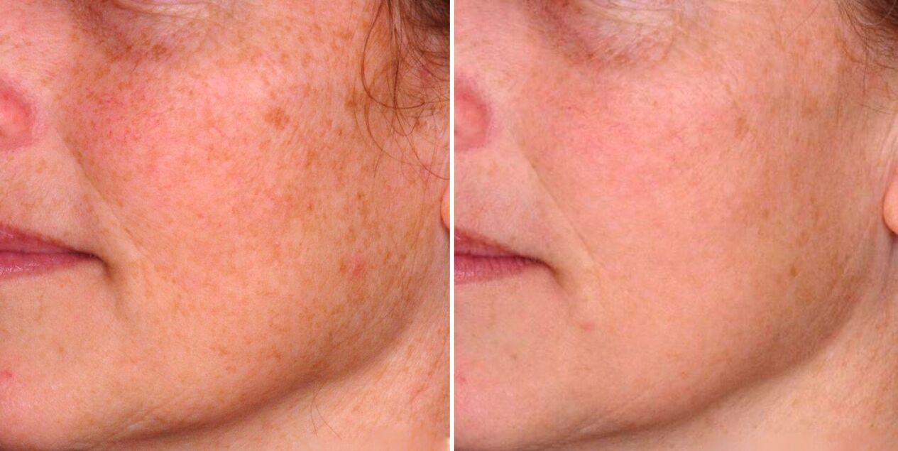 Výsledkom frakčnej fototermolýzy je redukcia stareckých škvŕn na pokožke tváre. 